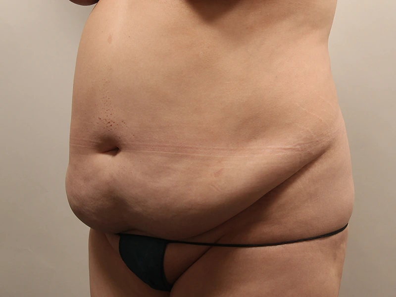 Tummy tuck before