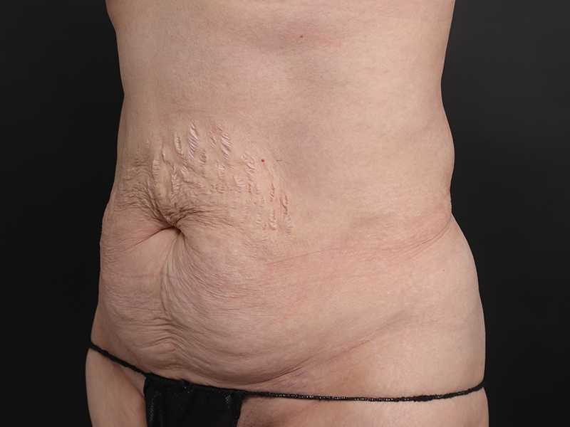 Tummy tuck before