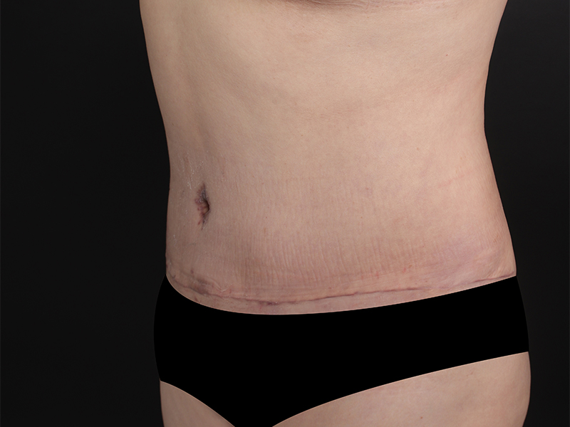 Tummy tuck before