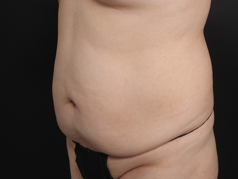 Tummy tuck before