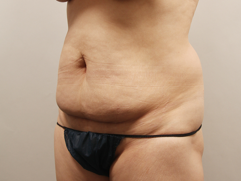 Tummy tuck before