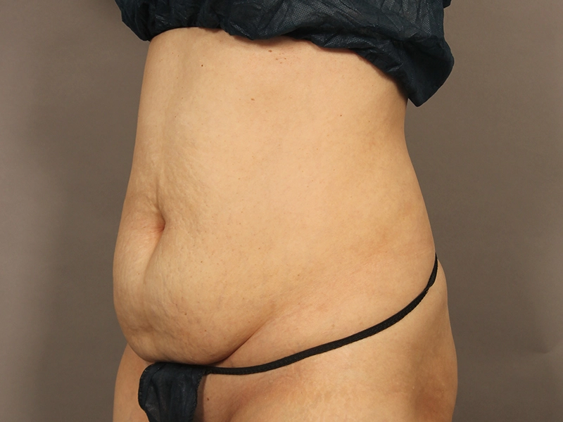 Tummy tuck before