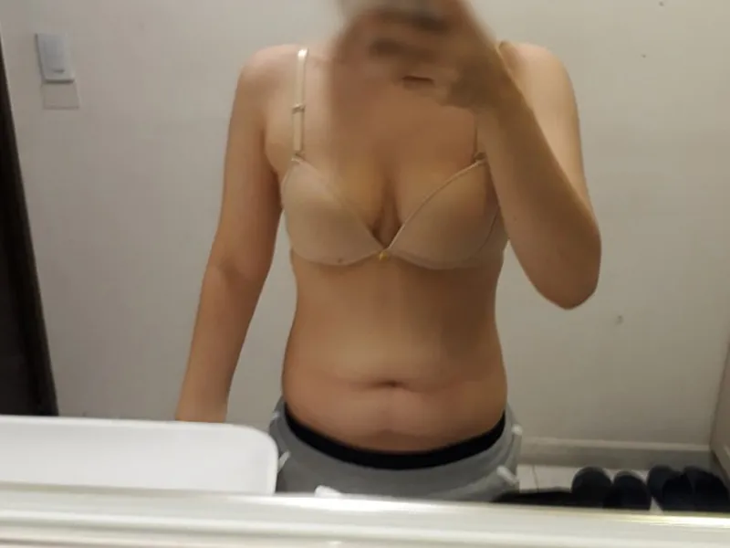 Breast augmentation before