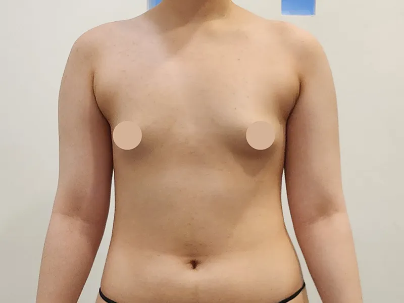 Breast fat transfer before