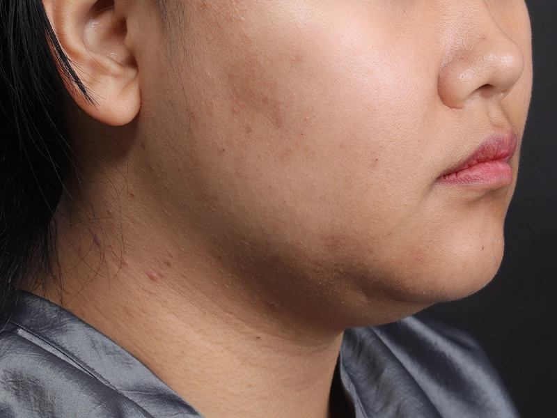 Face liposuction before