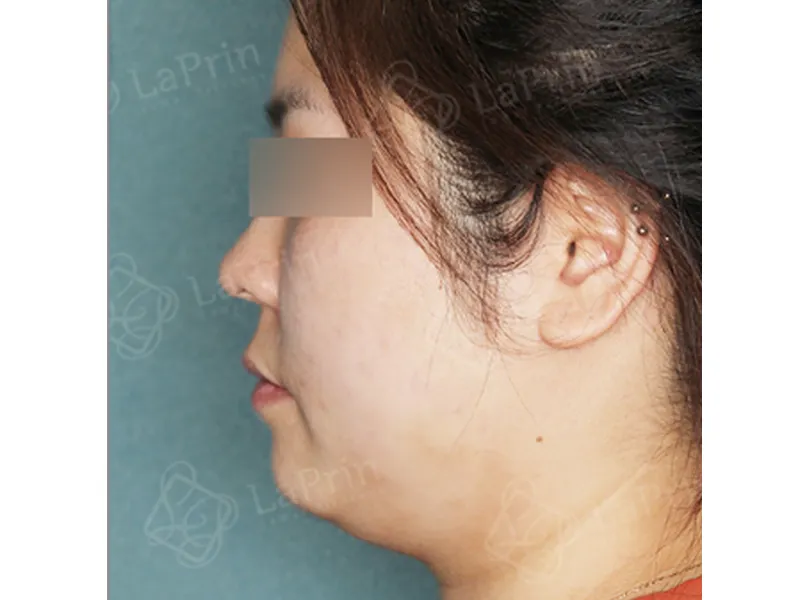Face liposuction before