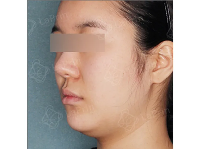 Face liposuction before