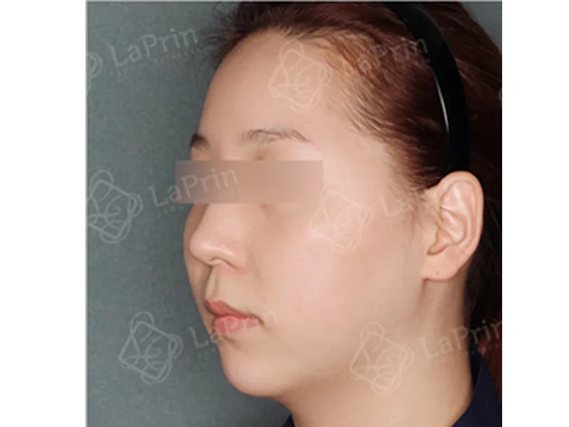 Face liposuction before