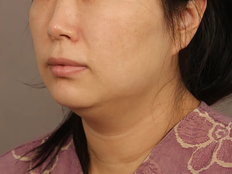 Face liposuction before