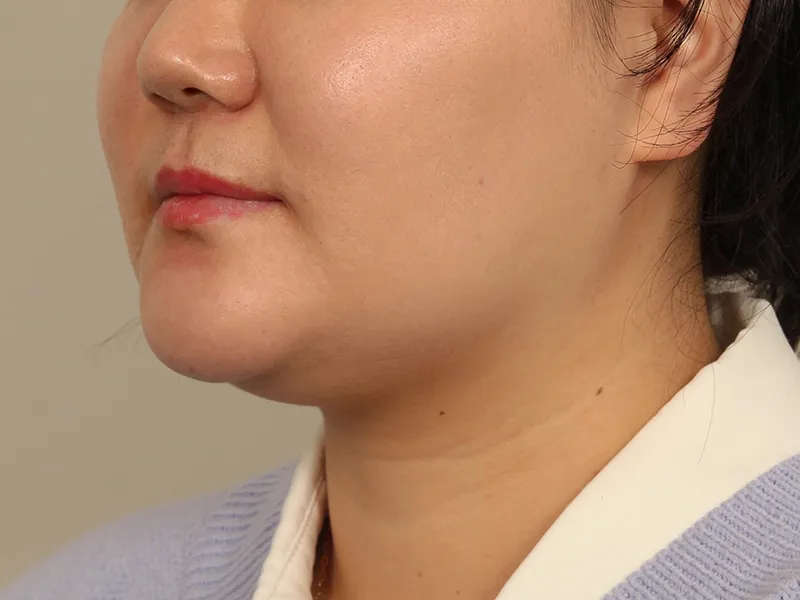Face liposuction before