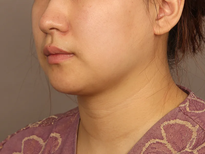 Face liposuction before