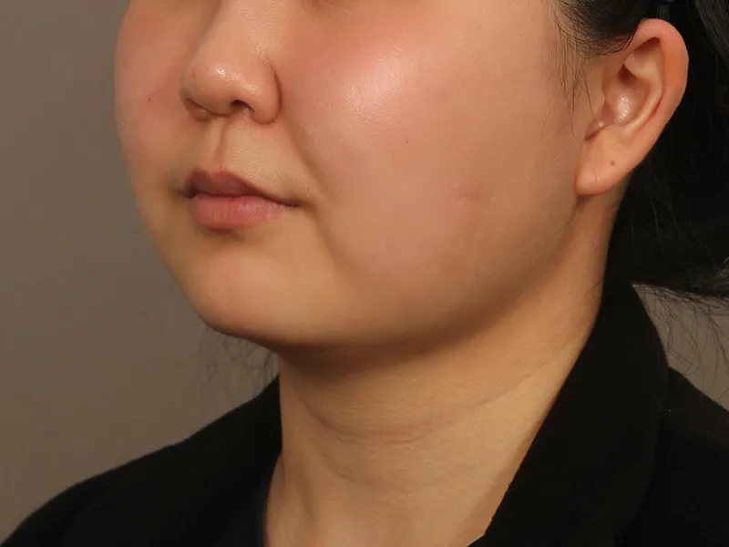 Face liposuction before