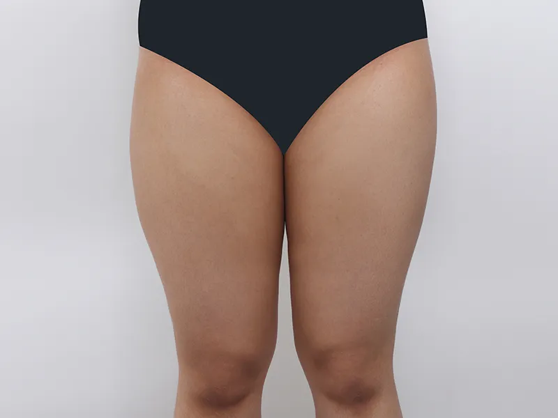 Thigh liposuction before