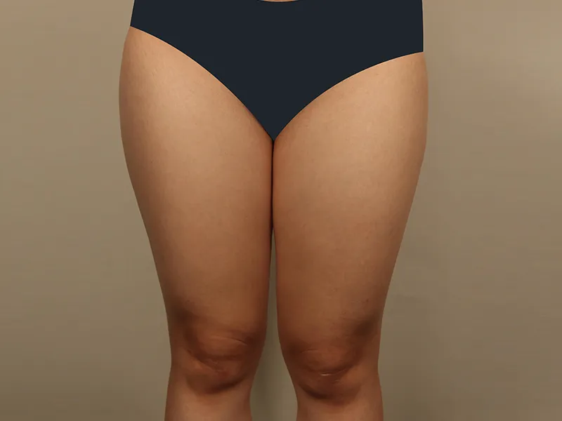 Thigh liposuction before