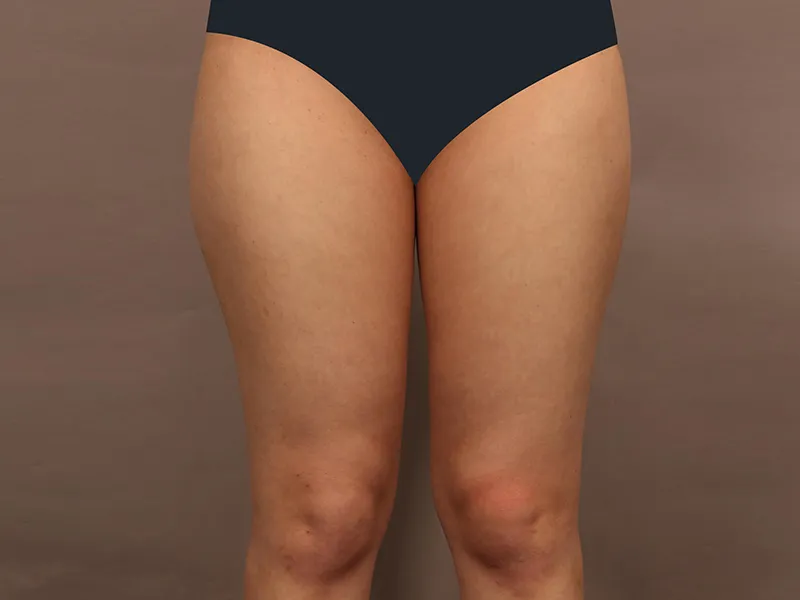 Thigh liposuction before
