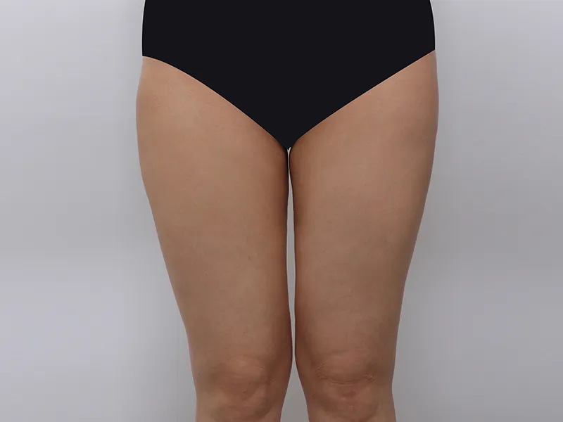 Thigh liposuction before