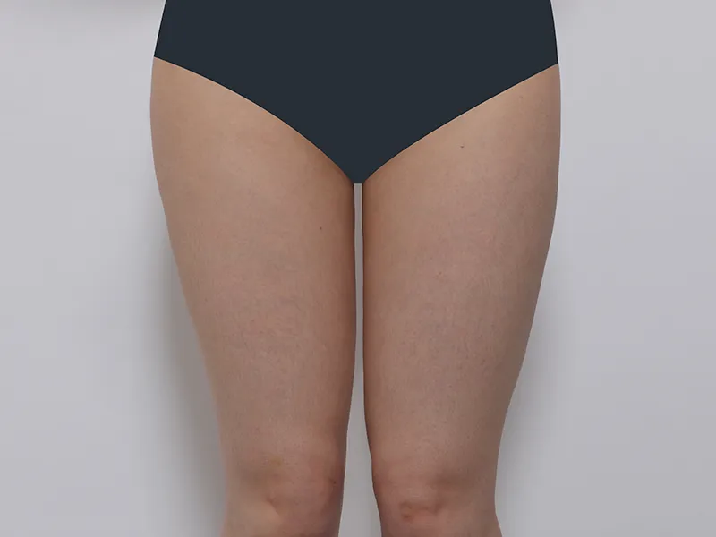 Thigh liposuction before