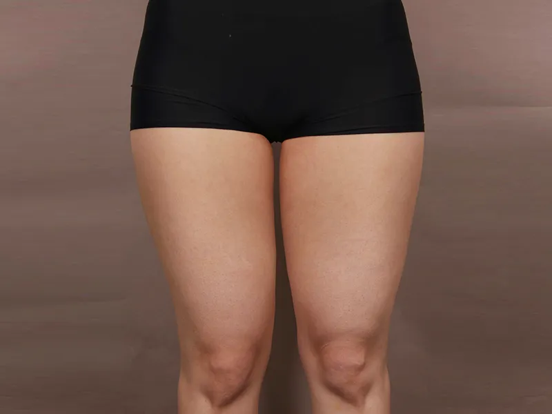 Thigh liposuction before