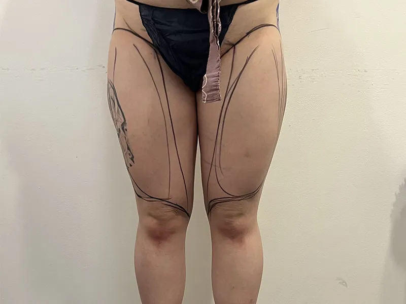 Thigh liposuction before