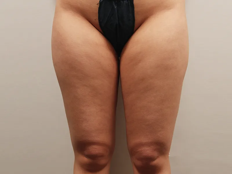 Thigh liposuction before