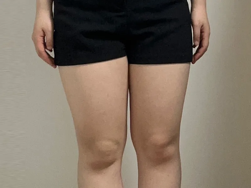 Thigh liposuction before
