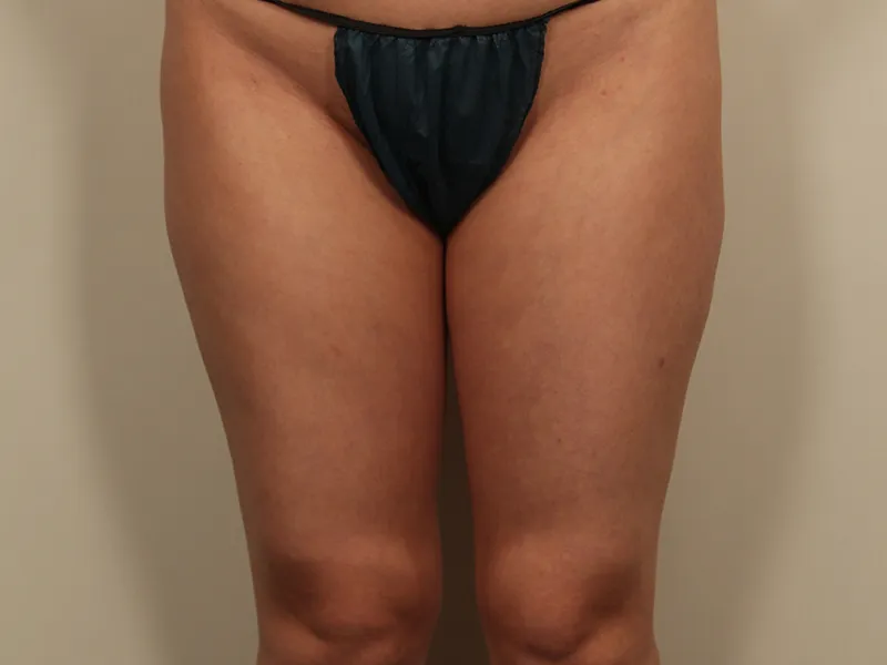 Thigh liposuction before