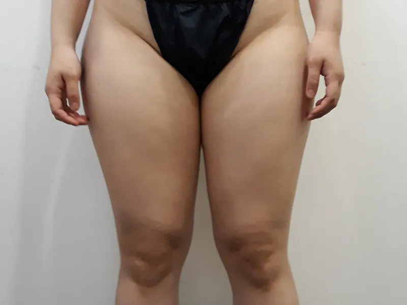 Thigh liposuction before